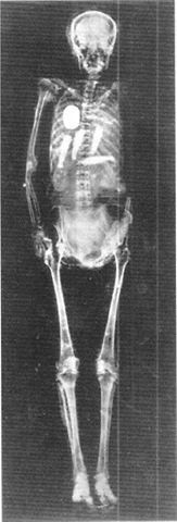  X-ray of Queen Nodjme, revealing a sacred heart scarab and amulets of the four sons of Horus within the mummy. 