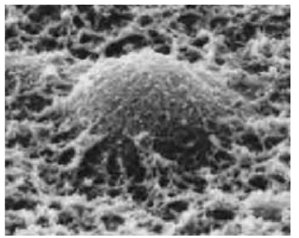Scanning electron micrograph of a human erythrocyte, or red blood cell, tangled in fibrin. Fibrin is the insoluble form of fibrinogen, a coagulation factor found in solution in blood plasma. Fibrinogen is converted to the insoluble protein fibrin when acted upon by the enzyme thromboplastin. Fibrin forms a fibrous meshwork, the basis of a blood clot, which is the essential mechanism for the arrest of bleeding. Red blood cells contain the pigment hemoglobin, the principal function of which is to transport oxygen around the body. Magnification: x6900 (at 10 x 8 in. size). 