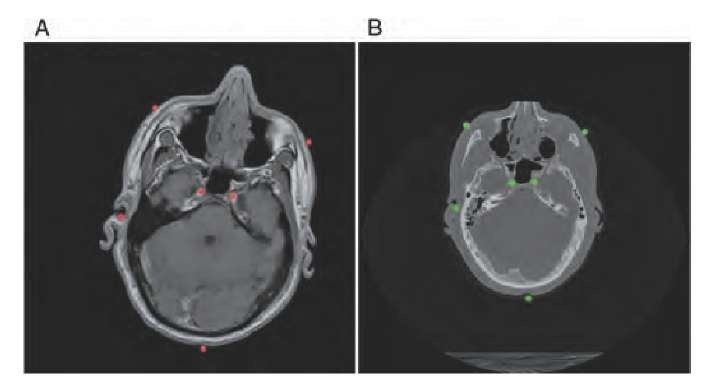  Matched but unregistered slices from the Visible Human data set. (A) shows a Ti>-weighted MR slice of the head, and (B) shows the corresponding CT slice. The images are mismatched in position, rotational orientation, and scale. Anatomy-based homologous fiducial markers (red in the MR image and green in the CT image) have been placed manually.