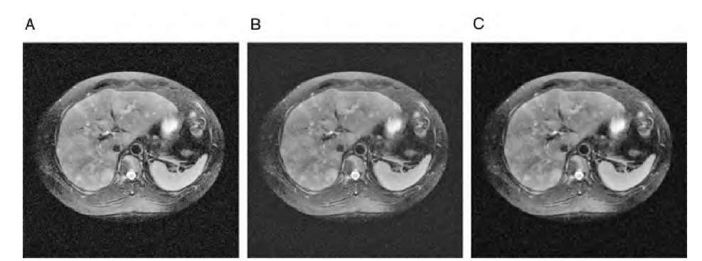  A first approach at attenuating noise in an image using the wavelet transform. The original image in Figure 4.8, a MRI slice with artificially added Gaussian noise (A), was decomposed as shown in Figure 4.8B, and the L/H, H/L, and H/H regions set to zero before reconstruction (B). The resulting image shows a considerable noise component, but on a coarser scale, very similar to the result of Gaussian blurring (C). 