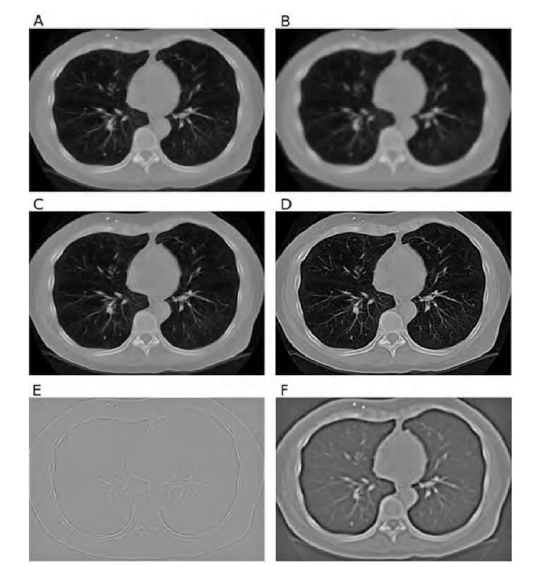 Demonstration of some convolution filters. The original image A is a CT slice of the chest and is 500 x 350 pixels in size. Image B was convolved with a Gaussian kernel with ct = 2.1 in a 13 x 13 neighborhood. Images C and D show the effect of sharpening: In image C the weaker sharpening mask of Equation (2.17) was used, and in image D, Equation (2.16) was applied. Image E is the result of a convolution with the Laplacian mask in Equation (2.15). Finally, image F demonstrates the effect of the DoG operator where the original image, convolved with a Gaussian kernel with ct = 4, was subtracted from the original image convolved with a Gaussian kernel with ct = 1.6. The result closely resembles the LoG operator (Figure 2.8C).