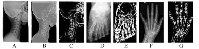 Input X-ray image of throat, B: Gray image of A after entropy analysis, C: Segmented bone image by the proposed algorithm, D: Input X-ray image of foot, E: Segmented bone image, F: Input X-ray image of broken wrist, G: Segmented bone image of F using the proposed method 