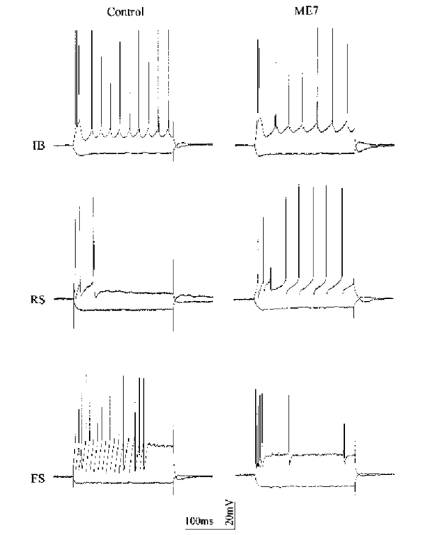 Types of neuron encountered in control and ME7 mice. Intracellular recordings were made in the subiculum of mice injected, 21 wk previously, with either normal brain homogenate or with ME7 homogenate. The records show, superimposed, the response of each neuron to a depolarizing current pulse (0.4 nA except for the control FS neuron, where it was 0.8 nA) and a hyperpolarizing current pulse (-0.4 nA). Intrinsically burst-firing (IB) and regular-spiking (RS) subtypes of pyramidal neuron are shown. Examples of fast-spiking neurons are given also. It was confirmed morphologically that these were nonpyramidal neurons, but no attempt was made to subtype them. The purpose of this figure is to demonstrate that the same types of neuron can be recorded and distinguished in ME7 as in control mice, and to suggest that failure to account for differences between subtypes could confound a comparison between control and scrapie mice. This figure is not intended to provide a summary of the differences postulated to be present between control and prion affected neurons. 