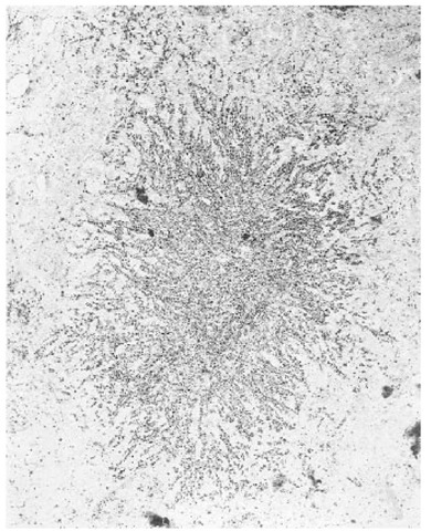 Electron microscope micrograph of a classic or kuru-type plaque located in the cerebral cortex of an 87 V scrapie-infected mouse. The preparation has been stained using an immunogold silver method, which reacts with PrP. The plaque shows the characteristic stellate appearance formed by radiating bundles of amyloid fibrils, which are decorated with immunogold silver reaction product, indicating that the fibrils are composed of PrP. 