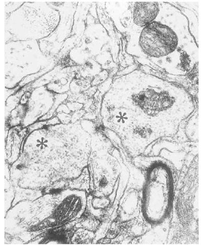 The thalamus from a naturally occurring case of feline spongiform encepha-lopathy is shown. Two dendrites (asterisks) contain large numbers of spherical or elliptical structures: so called tubulovesicular bodies. The size of these bodies can be compared to synaptic vesicles in an adjacent axon terminal (star) or cross-sectioned microtubules (arrowheads). Stained with uranyl acetate and lead citrate.