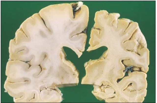 Alzheimer's disease. Sliced sections from two brains. On the left is a normal brain of a 70-year-old. On the right is the brain of a 70-year-old with Alzheimer's disease. The right brain is atrophied with a loss of cortex and white matter. Alzheimer's disease is not a normal part of aging. It is a dementing disorder that leads to the loss of mental and physical functions. The chance of developing this disease increases with age.