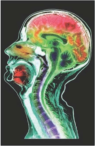 Colored magnetic resonance imaging (MRI) scan of a sagittal section through the brain of a 51-year-old male, showing cerebral atrophy. Atrophy of parts of the cerebrum of the brain occurs in various disorders, including stroke, Alzheimer's disease, and AIDS dementia. Here the area of the upper cerebrum affected by atrophy is colored dark red. Atrophy is shrinkage and wasting away of tissue. In stroke, brain cells die due to deprived blood supply to the brain; in Alzheimer's disease, the brain shrinks leading to senile dementia.