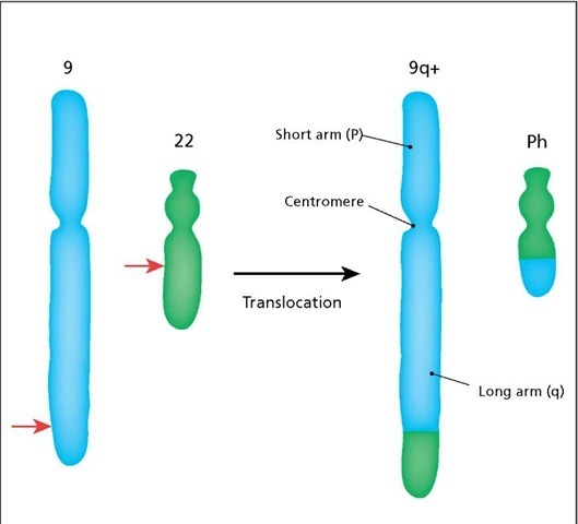 The Philadelphia chromosome (Ph) is produced by a translocation between the long arms of chromosomes 9 and 22. Red arrows mark the fragmentation points. The notation "9q+" indicates an addition to the long arm of chromosome 9. The chromosomes are aligned at the centromeres. 