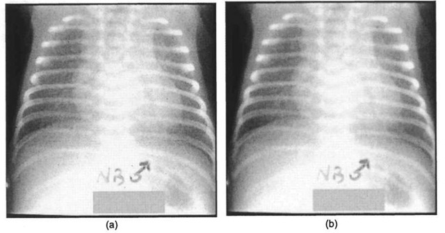 Reduction of quantum mottle noise by image smoothing (image courtesy of Neil Trent, Dept. of Radiology, Univ. of Missouri Health Care), (a) Original chest radiograph of infant. Note the speckled and grainy nature of the image, (b) Processed image, using an 1 lxl 1 Gaussian low-pass filter (ct=1). The grainy noise has been reduced, at the cost of spatial resolution. 