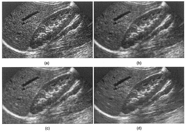 Ultrasound speckle noise removal, (a) Unprocessed ultrasound image of kidney anatomy, (b) Smoothed image (5x5 averaging filter), which while reducing speckle seriously degrades spatial resolution, (c) Result of adaptive filtering, using MATLAB wiener2 Image-Processing Toolkit function, (d) Commercial quality speckle tioise reduction, where image is despeckled using an adaptive geometric filter and then edge sharpened.