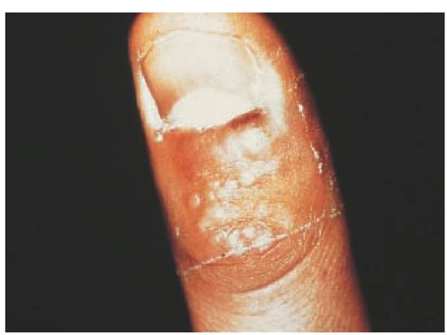 Herpetic whitlows, which occur on fingers, are often misdiagnosed as staphylococcal infections. 