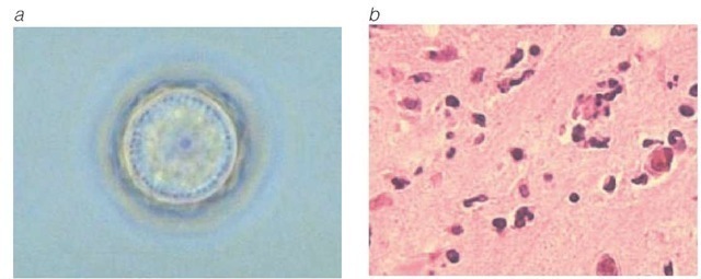  (a) Acanthamoeba polyphaga cyst. (b) A histopathologic slide shows A. polyphaga infection in a mouse brain. Similar histopathologic features are seen in Acanthamoeba meningoencephalitis, which generally occurs in immunocompromised persons.