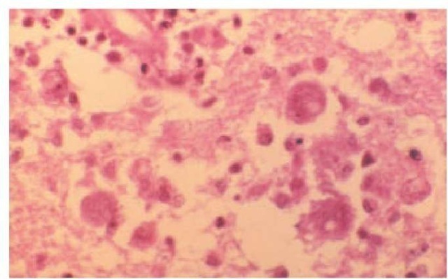 Naeglaria meningoencephalitis in a human brain, on hematoxylin-eosin stain.
