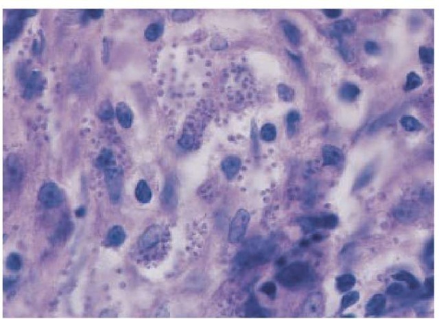 Amastigotes are demonstrated on Giemsa-stained biopsy tissue from an ulcer in a patient with Old World cutaneous leishmaniasis.