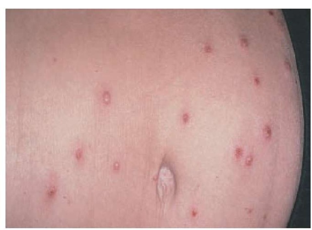The lesions characteristic of varicella-zoster virus infection often appear initially on the face and trunk and may present as maculopapules, vesicles, and scabs simultaneously. 