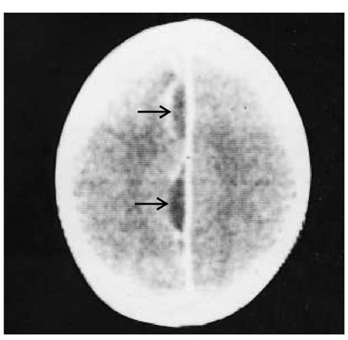 CT scan of a 17-year-old patient with a subdural empyema shows two loculations (arrows) that are restricted to the interhemis-pheric area. Contrast-enhanced margins surround the two loculations.