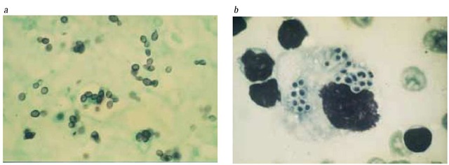 Shown are biopsy samples from an elderly man with chronic progressive disseminated histoplasmosis. (a) Tongue ulcer stained with methenamine-silver stain shows several budding yeast forms measuring 2 to 4 |im. (b) A smear from a lung biopsy sample, which is stained with Giemsa stain, shows small intracellular yeasts inside a macrophage.