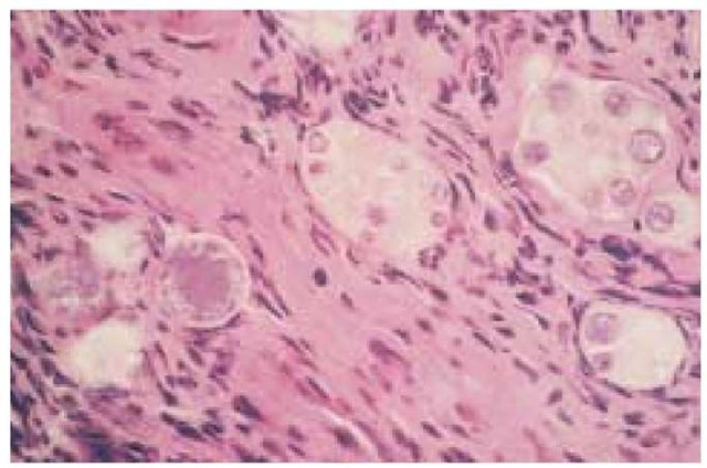 Shown is a transbronchial lung biopsy specimen, stained with hematoxylin-eosin stain, from a patient with advanced HIV infection and diffuse reticulonodular pulmonary infiltrates. Large spherules (measuring 60 to 80 |im) of C. immitis in various stages of maturation are evident.