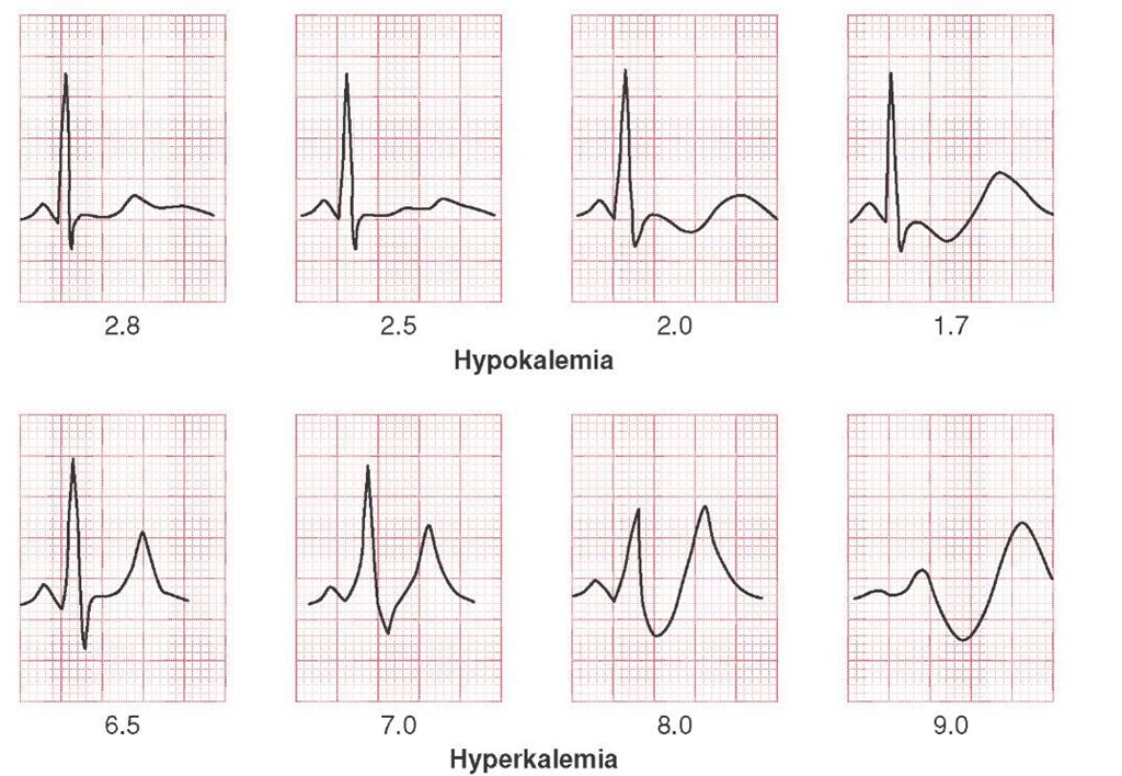 ECG changes associated with hypokalemia and hyperkalemia. 