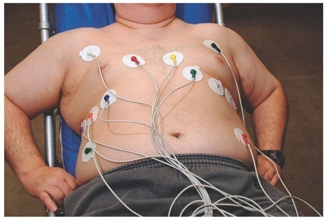 Lead placement for a 15-lead ECG, which is helpful in assessing the right ventricle. 