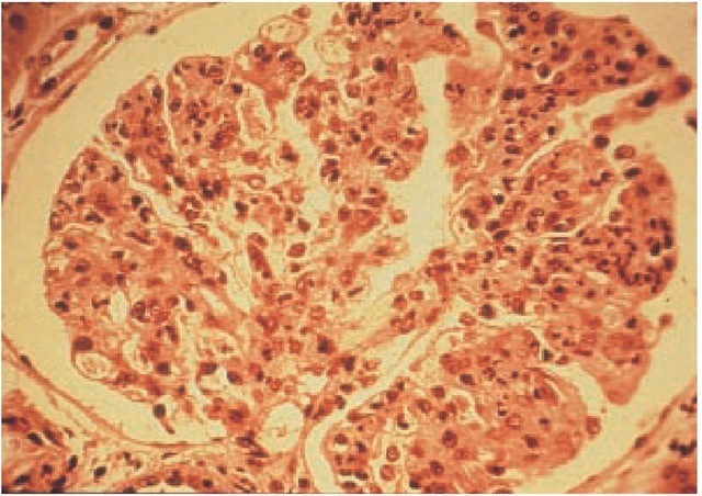 Light micrograph of poststreptococcal glomerulonephritis showing increased glomerular hypercellularity.