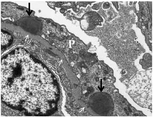 Transmission electron micrograph (magnification: x 10,500) showing characteristic subepithelial hump-shaped deposits (illustrated by thick arrows) in postinfectious glomerulonephritis lying below the podocytes (P); small arrows indicate the glomerular basement membrane.