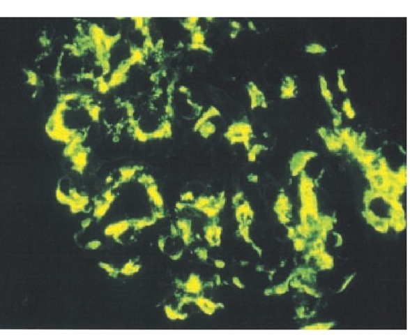 IgA immunostaining showing IgA deposition in a typical mesangial cell distribution in IgA nephropathy.