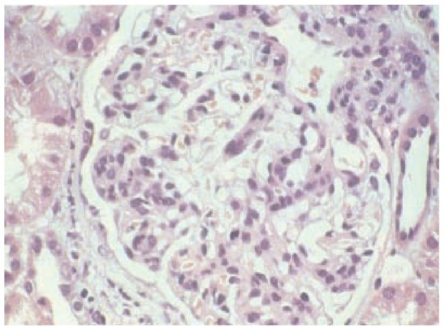 Light micrograph from a patient with IgA nephropathy showing the characteristic glomerular hypercellularity.