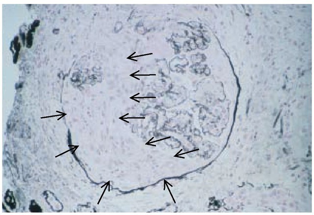 A large multilayer of cells in the Bowman space (arrows) represents a typical crescent in anti-glomerular basement membrane disease.