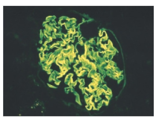 Linear pattern of IgG immunostaining along the GBM in a patient with anti-GBM disease.