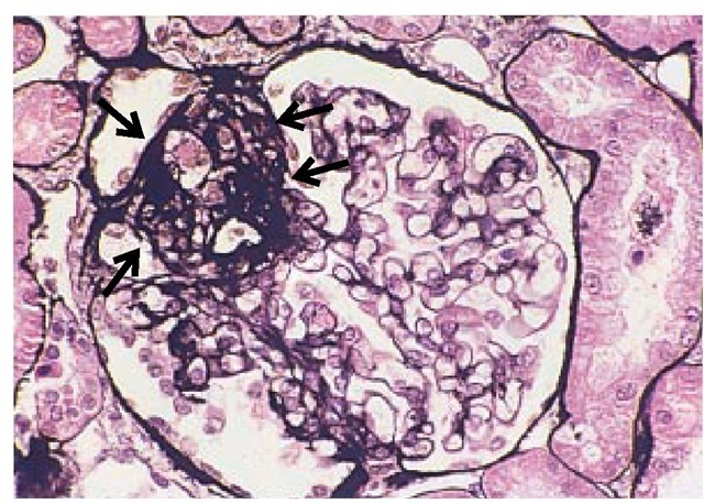 Light micrograph showing the characteristic features of focal segmental glomerulosclerosis, with collapse of capillaries, hyalinosis, and adhesion (area highlighted by arrows).