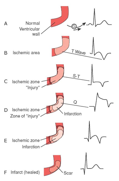 Wave changes during evolution of myocardial damage. 