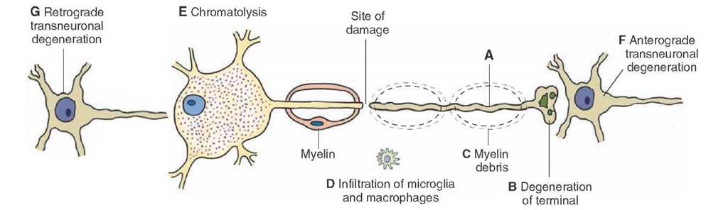 Effects of axonal injury. (A-D) Wallerian degeneration. (E) If the injury is close to the cell body, chromatolysis occurs in the cell body. (F) In the central nervous system, the neuron receiving input from a degenerated axon undergoes anterograde transneuronal degeneration, and (G) the neuron, from which the inputs to the chromatolytic neuron arise, degenerates. 