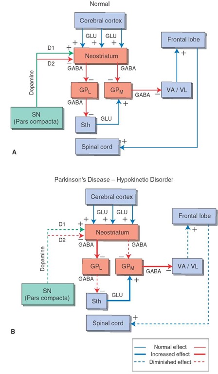 Schematic diagram depicting the possible mechanisms for hypokinetic and hyperkinetic disorders. (A) Normal input-output relationships of the basal ganglia. GLU = glutamate; GABA = gamma aminobutyric acid; GPL = lateral pallidal segment; GPM = medial pallidal segment; SN = substantia nigra; Sth = subthalamic nucleus; VA = ventral anterior thalamic nucleus; VL = ventrolateral thalamic nucleus. (B) Hypokinetic disorder (Parkinson's disease). This model proposes that the hypokinetic effect is manifested by the reduced quantities of dopamine released, which act on dopamine D, and D2 receptors in the neostriatum. Dopamine acting through D, receptors in the neostriatum is excitatory to GABAergic neurons, which project to the GPM (direct pathway). Moreover, dopamine acting through D2 receptors in the neostriatum inhibits GABAergic neurons, which project to the GPL segment (indirect pathway). When there is diminished dopamine in the neostriatum released onto D, receptors (dotted line), the resulting inhibitory output of the neostriatum on the GPM is diminished. This allows for an enhancement of the inhibitory output of the GPM to the thalamus to be increased (thicker arrow). Because the thalamus normally excites the cortex, greater inhibition on the thalamic nuclei by the GPM will cause a weakened input to motor regions of the cortex. Likewise, the projection from the neostriatum, acting through D2 receptors, is inhibitory to the GPL. In turn, the GPL is normally inhibitory to the Sth. Thus, the diminished inhibitory input into the neostriatum from SN allows the neostriatum to exert greater inhibition on GPL, which, in turn, results in a weakened inhibition upon the Sth. Because the Sth normally excites the GPM via a glutamatergic mechanism, the reduced amount of inhibition on the Sth would allow it to exert a greater excitatory effect on the GPM. Therefore, the combined effects of reduced dopaminergic inputs into the neostriatum affect both the direct and indirect pathways in such a way as to allow for enhancement of the inhibitory outputs of the GPM on the thalamic projection nuclei and their target regions in motor cortex, causing the hypokinetic movement disorder.