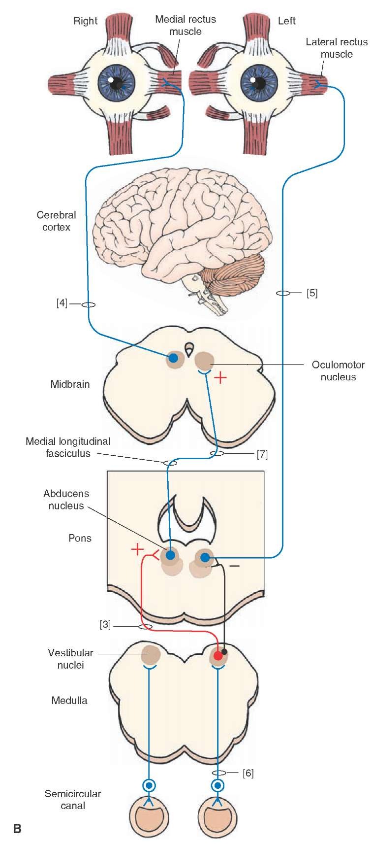 (B) This diagram illustrates other important relationships essential for conjugate gaze and the regulation of the vestibular-ocular reflex. An essential element in this relationship includes vestibular inputs to vestibular nuclei (6). Vestibular nuclei project to the ipsilateral cranial nerve (CN) VI, which is inhibitory, and to the contralateral CN VI, which is excitatory (3). Projections from CN VI to the contralateral CN III are also excitatory (7). The medial longitudinal fasciculus contains fibers passing from vestibular nuclei and the pontine gaze center to CN VI and III as well as fibers passing from CN VI to the contralateral CN III. To illustrate how these relationships function, assume that the head is rotated to the left. The net result is that the eyes are rotated to the right. In order for this to be achieved, there must be contraction of the right lateral rectus and left medial rectus muscles. Activation of these muscles is induced by initial activation of vestibular nerve fibers originating from the left horizontal semicircular canal, which project to vestibular nuclei. Projections from left vestibular nuclei to the right abducens nucleus are excitatory, causing contraction of the lateral rectus muscle of the right eye. Because the projection from the right abducens nucleus to the left oculomotor nucleus is also excitatory, activation of the right abducens nucleus results in excitation of the left medial rectus muscle. Because the projection from the left vestibular nucleus to the ipsilateral (left) abducens nucleus is inhibitory, the left lateral rectus muscle will have a greater tendency not to contract; likewise, the excitatory projection from the left abducens nucleus to the right oculomotor nucleus would not be activated because of the inhibitory input from the vestibular nuclei; therefore, reducing the likelihood of excitation of the right medial rectus muscle. 