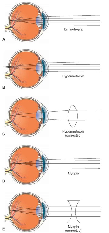 Errors in refraction. (A) Normal (emmetropic) eye. (B) In hypermetropia (hyperopia, far-sightedness), light rays are focused behind the retina when the ciliary muscle is completely relaxed. (C) Hypermetropia can be corrected by placing a convex lens of appropriate strength in front of the eye. (D) In myopia (near-sightedness), the light rays coming from a distant object are focused in front of the retina when the ciliary muscle is completely relaxed. (E) Myopia can be corrected by placing a concave lens of an appropriate strength in front of the eye. 