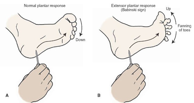 Illustration of a Babinski test. The sole of the foot is stroked with a sharp object from front to back. This kind of stimulation typically produces flexion of the foot (A). However, a patient who has an upper motor neuron paralysis will show extension of the large toe coupled with a fanning out of the other toes (B).