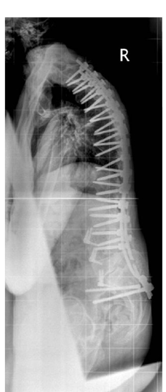 Lateral radiograph showing extensive spinal fixation. 