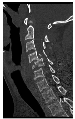 CTscan showing disruption of the anterior column at C4/5/6. 