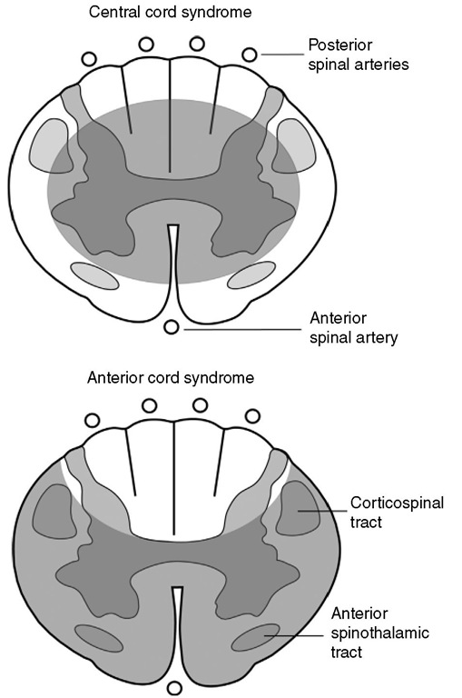 Diagram of the characteristic ischaemic areas in anterior and central cord syndromes. 