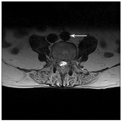  MRI scan showing the proximity of the aorta and inferior vena cava to the spine (arrow). Surgeons can perforate the great vessels during discectomy, but bleeding into the disc space does not occur, probably because the disc annulus and the anterior longitudinal ligament seal the path. 