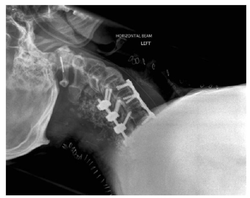 Radiograph of anterior and posterior fixation for cervical spine fracture. Post-operative airway obstruction due to soft tissue swelling is likely and extubation should be delayed.