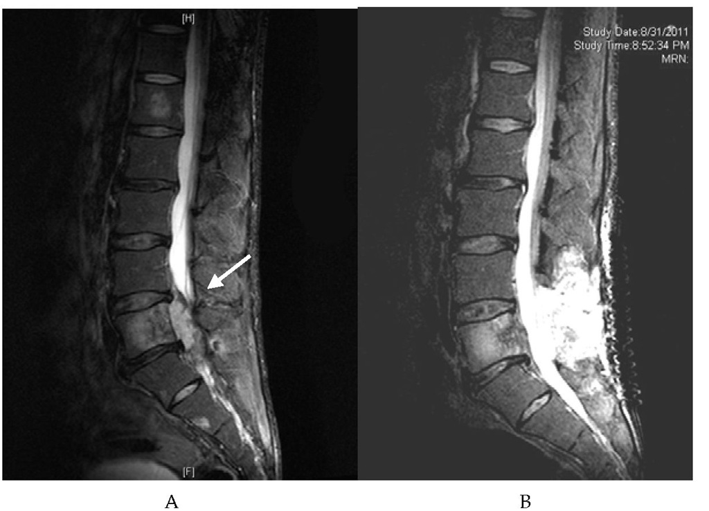 MRI of the lumbar spine. A 42-year-old male presented with cauda equina syndrome due to an epidural metastasis to the lumbar spine from a synovial sarcoma originating in the left lower limb. (A) Preoperative T2-weighted sagittal MRI demonstrating a metastasis to the L4 vertebral body invading the epidural space and compressing the thecal sac (arrow). The patient underwent laminectomy and resection of the epidural mass. (B) Postoperative T2-weighted sagittal MRI showing post-laminectomy decompression of the thecal sac.  