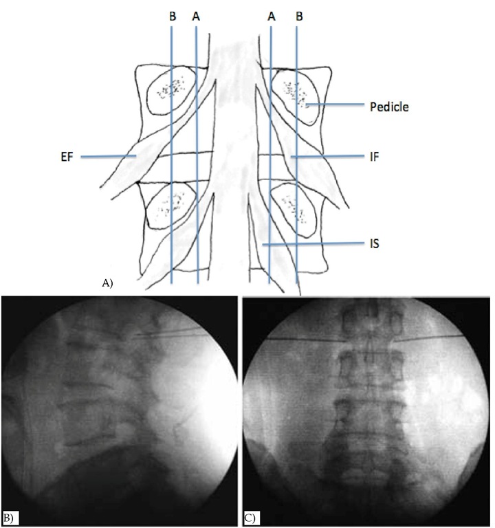 DRG anatomy and ideal RF needle tips position landmark on fluoroscopy A: Positions of dorsal root ganglia (DRG) were determined by two schematic lines and classified into three types. Line A: aligning the medial borders of L4 and L5 pedicles, Line B: aligning the centers of L4 and L5 pedicles, Intraspinal type (IS) : DRG located proximal to line A, Intraforaminal type (IF) : DRG located between line A and B, Extraforaminal type (EF) : DRG located distal to line B. B & C: Lateral (B) and anteroposterior (C) radiographs showing ideal RF needle tips position of L2 DRG. 