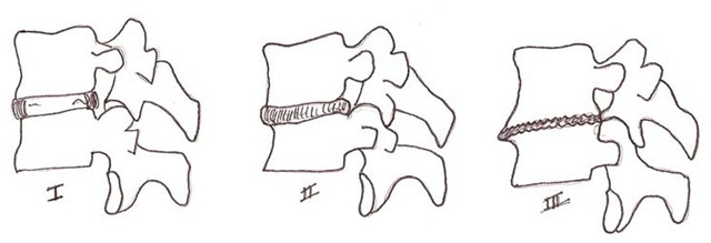 The degenerative cascade described by Kirkaldy-Willis and Farfan (1982). At the third phase, the disc lost height and facet hypertrophy promotes segment stabilization, but also narrowing the neural foramen and the vertebral canal (stenosis) 