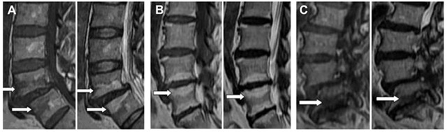  The overload in the endplates, caused by disc degeneration, induces changes in the MRI. A) Modic type 1, the endplates are black in T1 incidence and white in 2 incidence (edema). B) The enplates are white in both T1 and T2 incidences (fat). C) The endplates are black in both incidences (sclerotic).