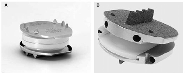 Total disc replacement in lumbar Spine: A) Sb-Charite, B) ProDisc prosthesis 