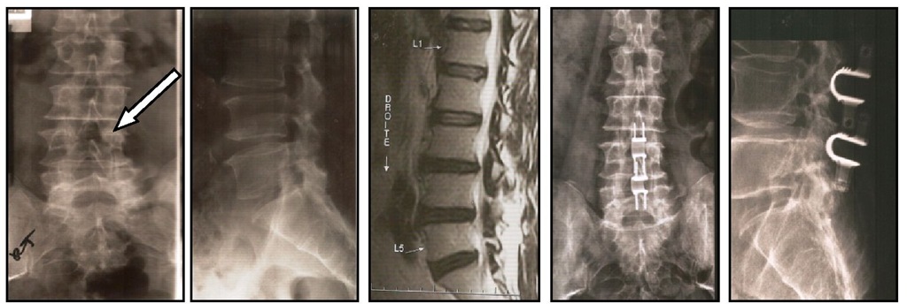 L4 Suspended vertebra treated with 2 interspinous spacers L3-L4 and L4-L5, fixing the L4.