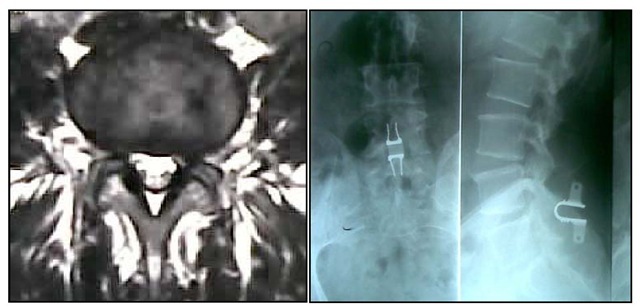 Facet syndrome: lack of synovial fluid at the level of L4-L5 joint; a sign of degeneration. 