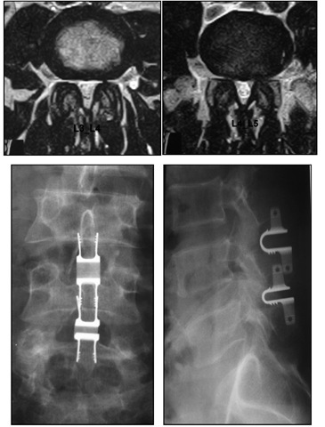 Top: Bi foraminal stenosis more so at the level L4-L5 then at L3-L4 levels. Bottom: X-ray of adjacent interspinous spacer. 